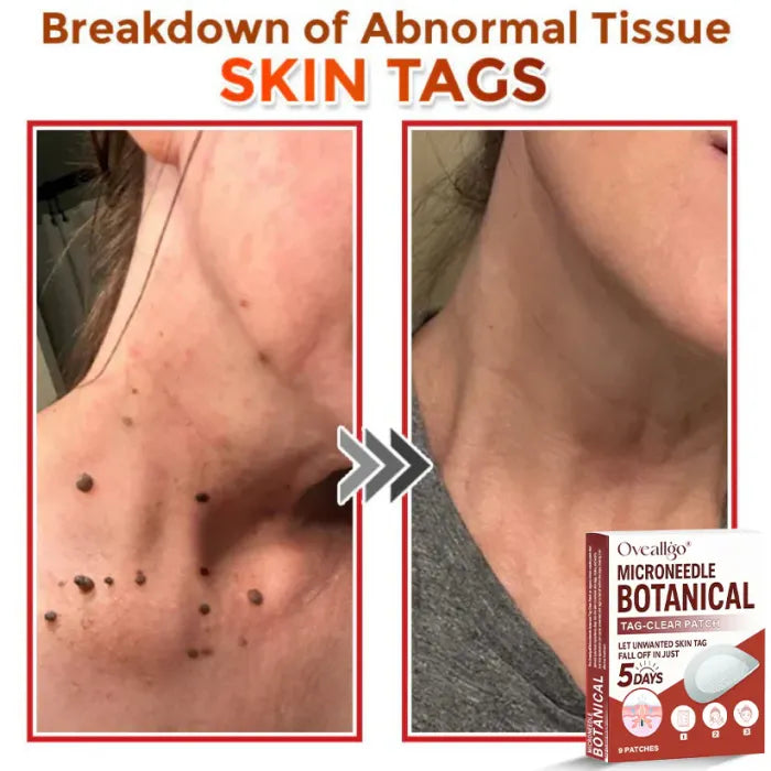Botanic Skin Tag Removal Patch